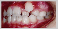 歯列矯正 1：叢生（そうせい）　治療前