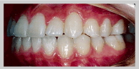 歯列矯正 1：叢生（そうせい）　治療後
