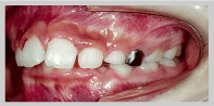 歯列矯正 2：上顎前突　治療前