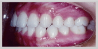 歯列矯正 3：反対咬合　治療後