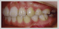 歯列矯正 4：開咬　治療後